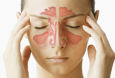 What are the different types of sinusitis?